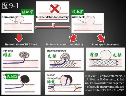 当骨科医生遇到假性动脉瘤，只能这么治！