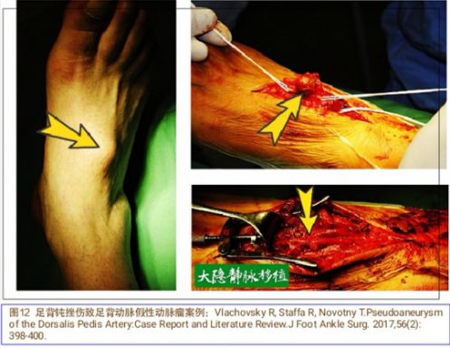 当骨科医生遇到假性动脉瘤，只能这么治！