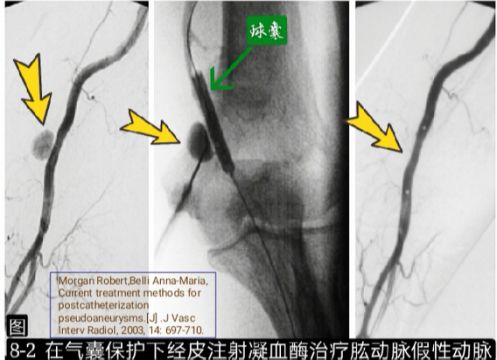 当骨科医生遇到假性动脉瘤，只能这么治！