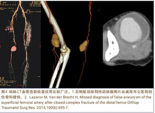 当骨科医生遇到假性动脉瘤，只能这么治！