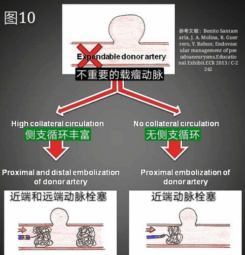 当骨科医生遇到假性动脉瘤，只能这么治！