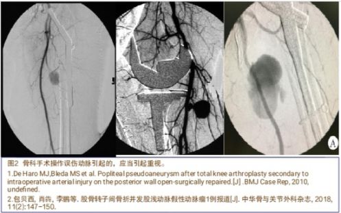 当骨科医生遇到假性动脉瘤，只能这么治！