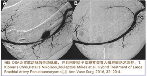 当骨科医生遇到假性动脉瘤，只能这么治！