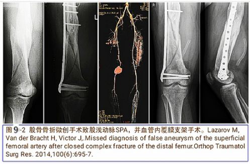 当骨科医生遇到假性动脉瘤，只能这么治！