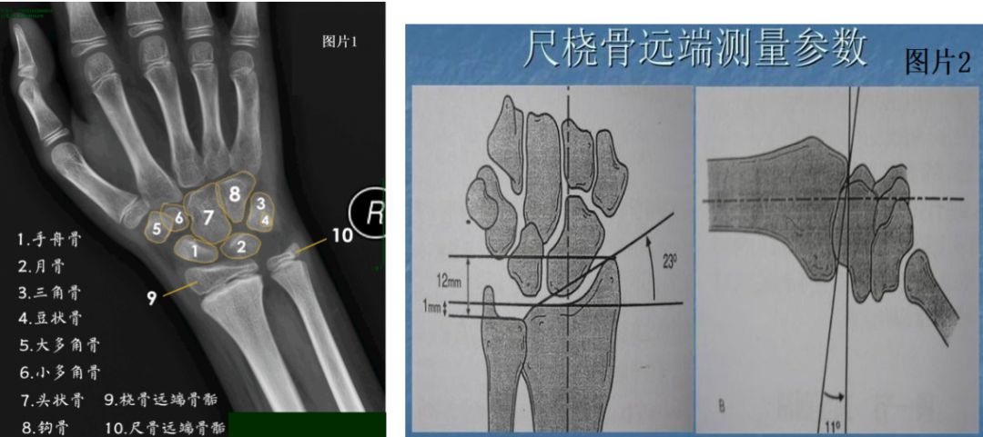 骨折 位 端 橈骨 遠