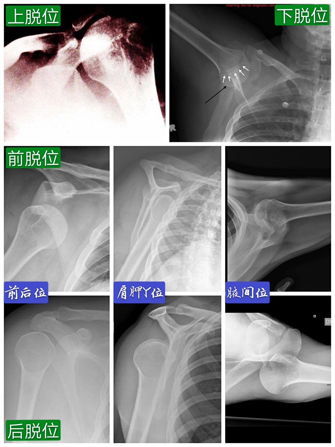 你的锁骨是斜的吗？--耸肩全攻略 - 知乎