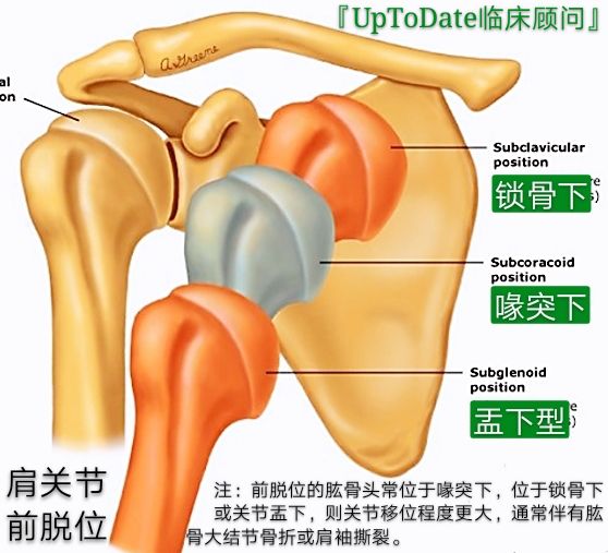 急性肩关节脱位处理方法大全，骨科医生必看！