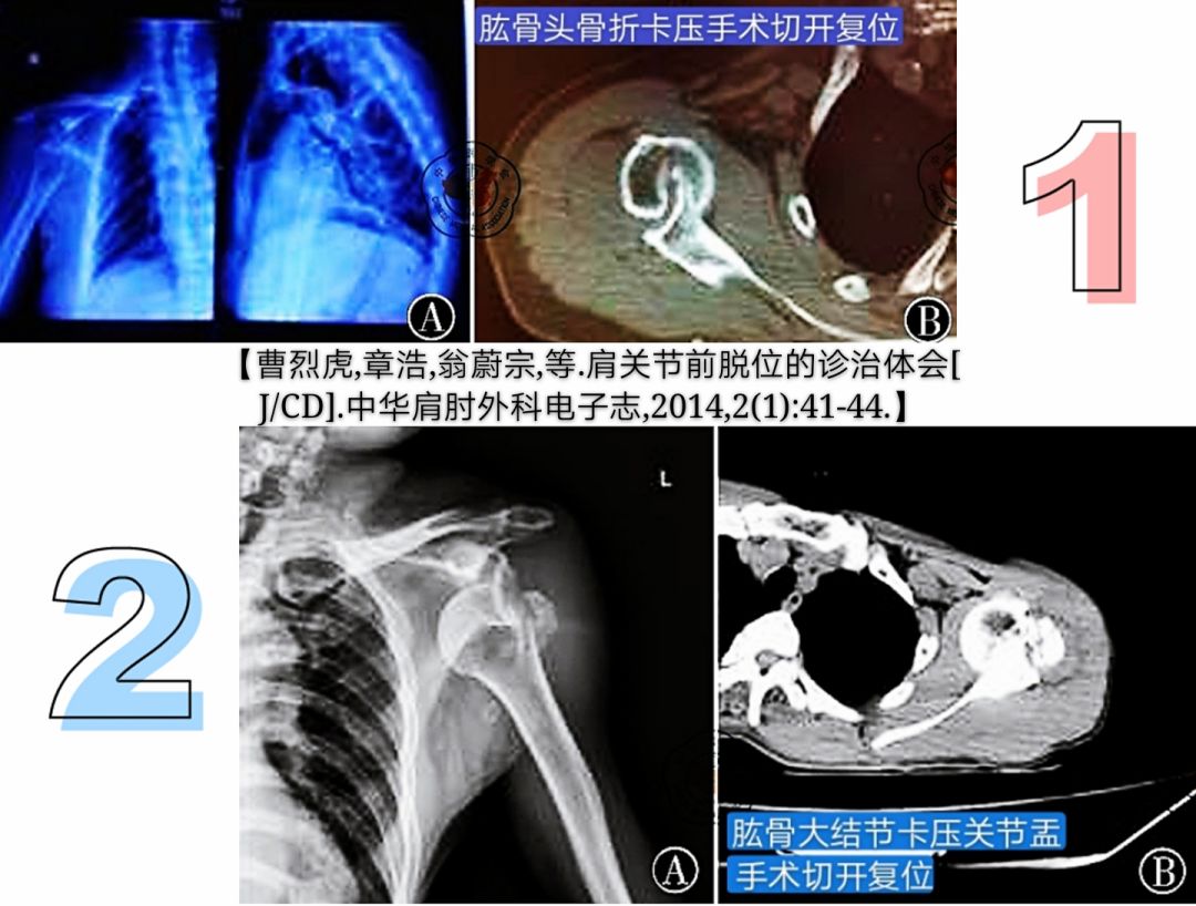 急性肩关节脱位处理方法大全，骨科医生必看！