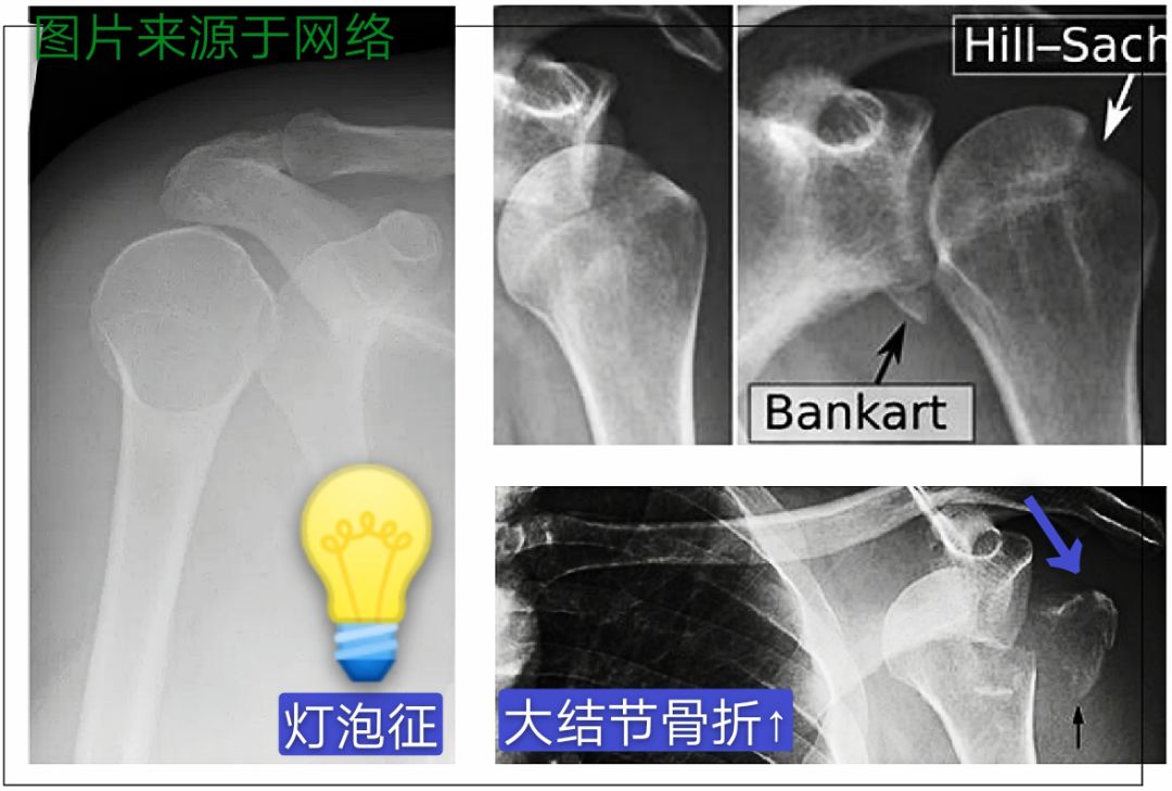 急性肩关节脱位处理方法大全，骨科医生必看！