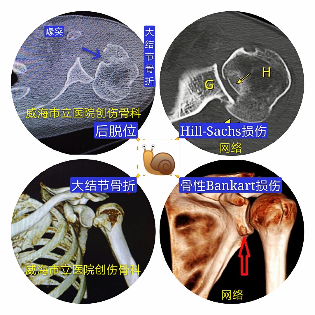 急性肩关节脱位处理方法大全，骨科医生必看！