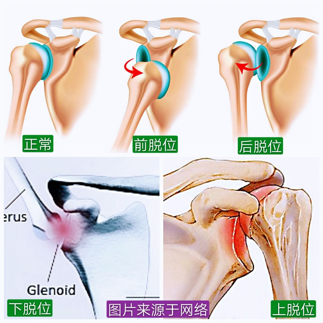 急性肩关节脱位处理方法大全，骨科医生必看！