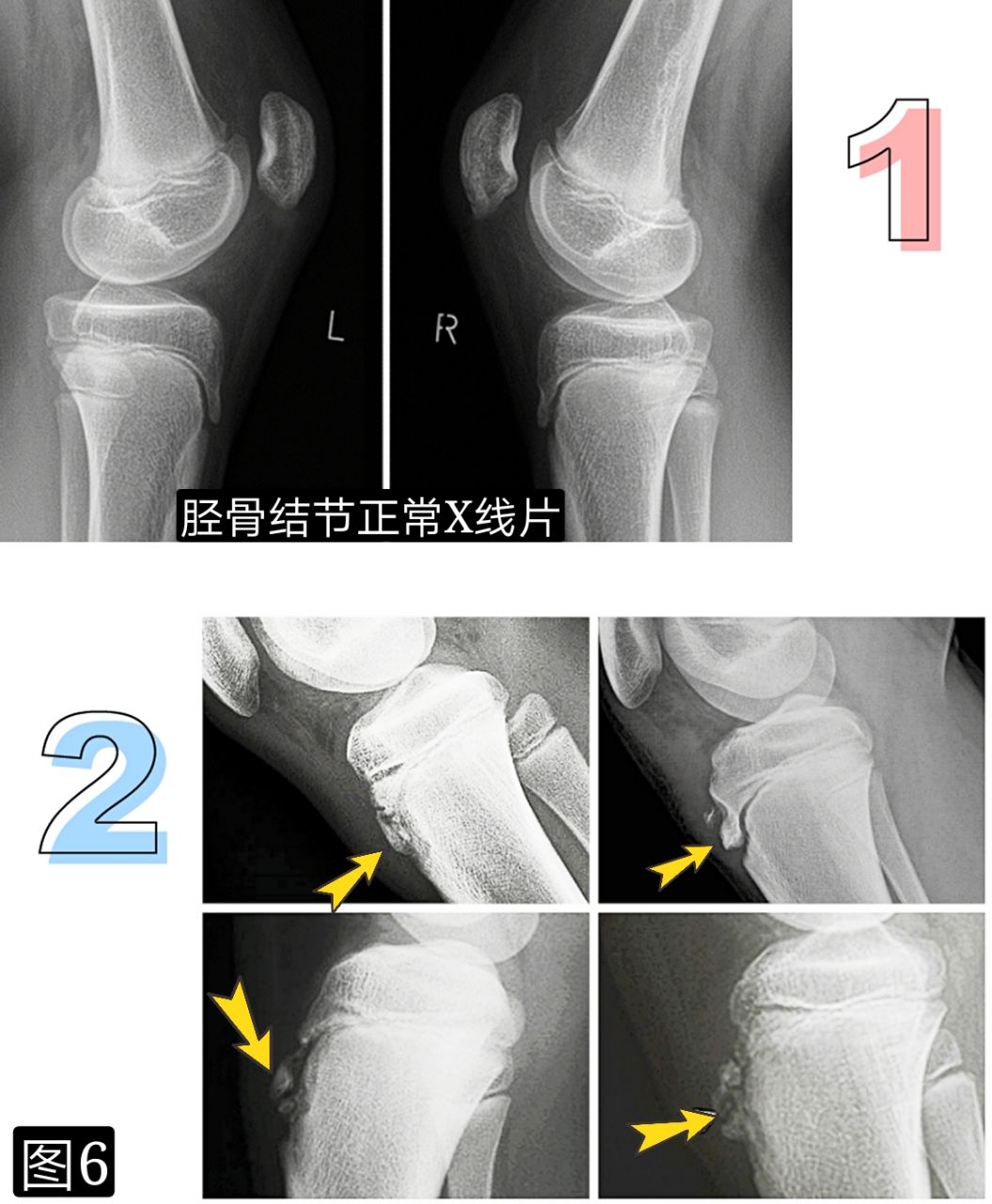 关于皮肌炎患者的膝盖退变（骨质增生）的治疗疑问_百度知道