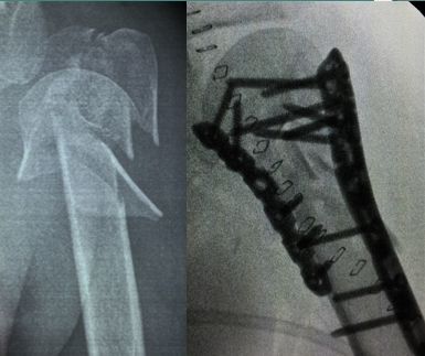 肱骨近端骨折手术关键点，看过的都收藏了！