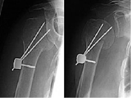 肱骨近端骨折手术关键点，看过的都收藏了！