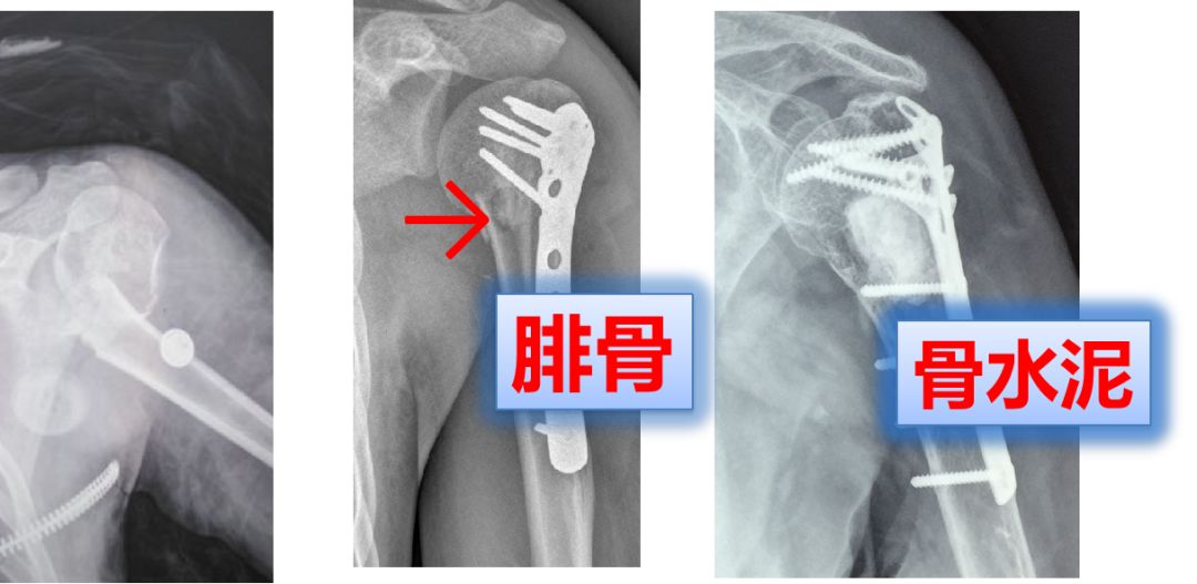 肱骨近端骨折手术关键点，看过的都收藏了！