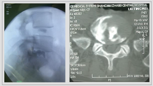 椎间盘源性腰痛如何选择最优治疗策略?技巧要点在这!