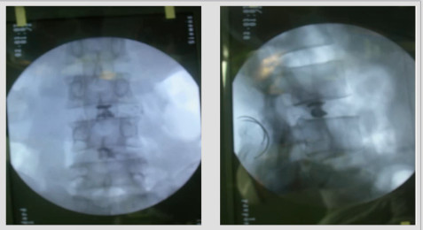 椎间盘源性腰痛如何选择最优治疗策略?技巧要点在这!