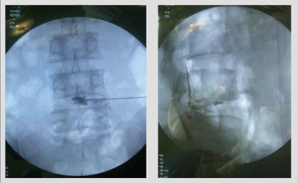 椎间盘源性腰痛如何选择最优治疗策略?技巧要点在这!