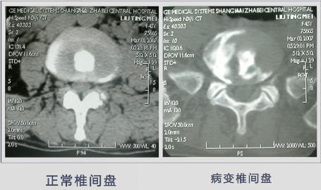 椎间盘源性腰痛如何选择最优治疗策略?技巧要点在这!