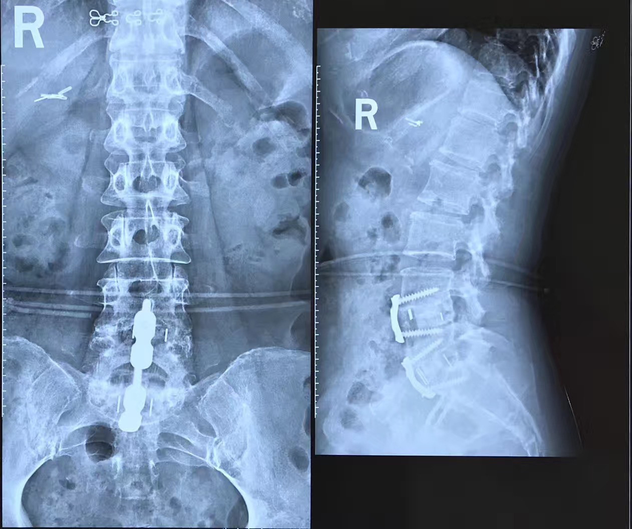 椎间盘源性腰痛如何选择最优治疗策略?技巧要点在这!