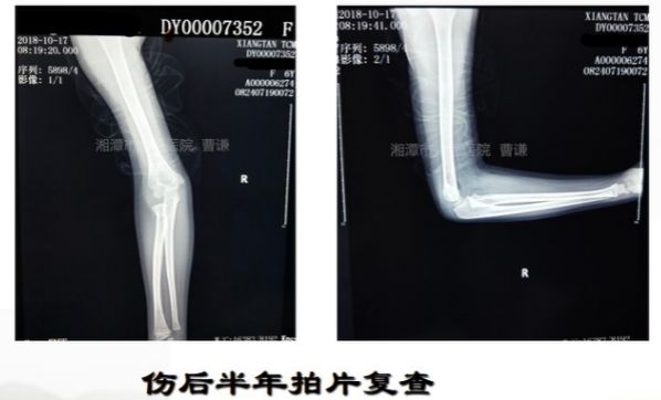 骨科医生必须掌握：桡骨颈骨折的7种治疗方法！