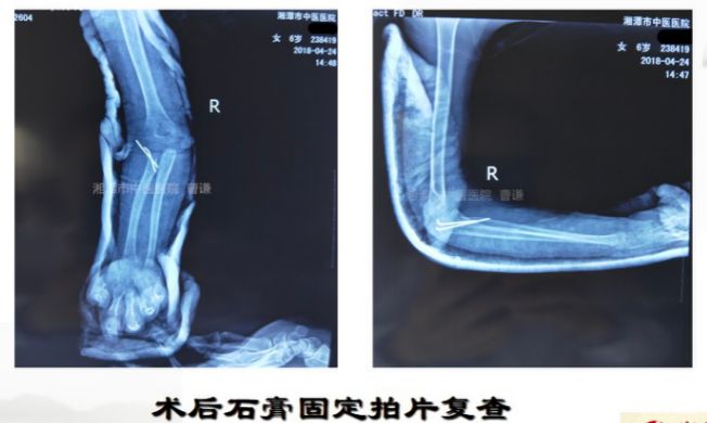 骨科医生必须掌握：桡骨颈骨折的7种治疗方法！