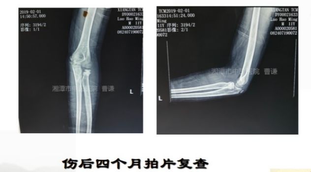 骨科医生必须掌握：桡骨颈骨折的7种治疗方法！