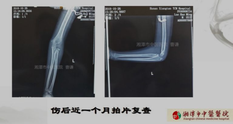 骨科医生必须掌握：桡骨颈骨折的7种治疗方法！