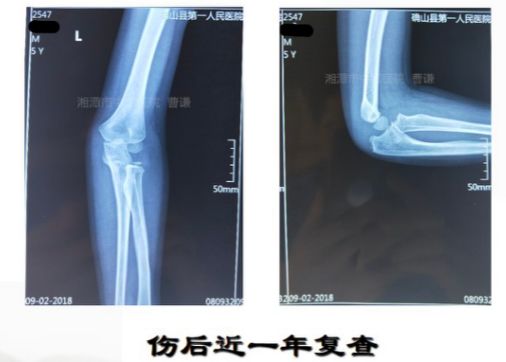 骨科医生必须掌握：桡骨颈骨折的7种治疗方法！