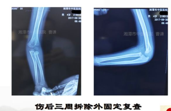 骨科医生必须掌握：桡骨颈骨折的7种治疗方法！