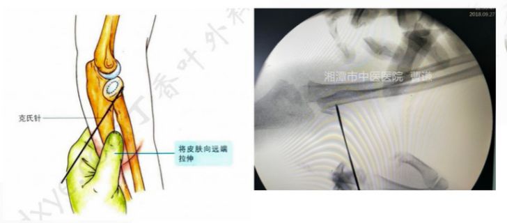 骨科医生必须掌握：桡骨颈骨折的7种治疗方法！