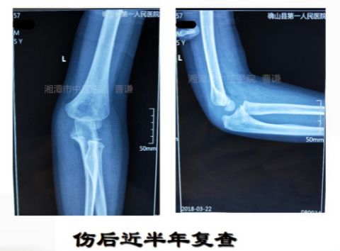 骨科医生必须掌握：桡骨颈骨折的7种治疗方法！