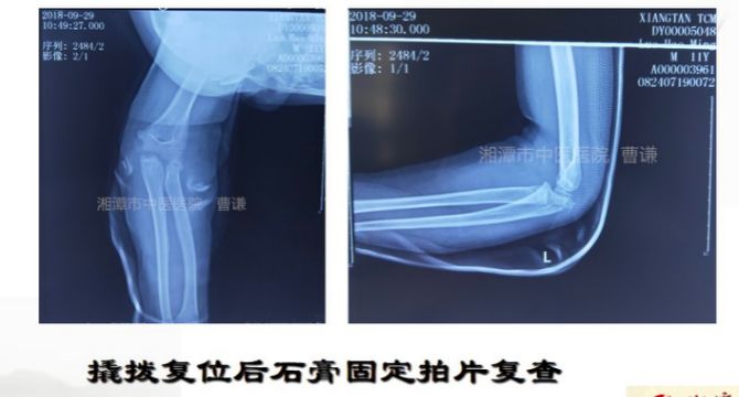 骨科医生必须掌握：桡骨颈骨折的7种治疗方法！