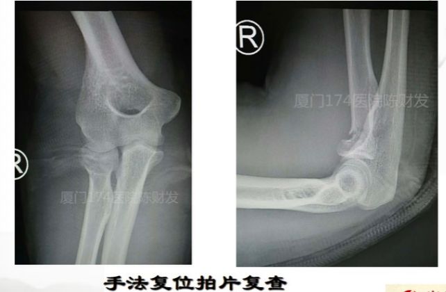 骨科医生必须掌握：桡骨颈骨折的7种治疗方法！