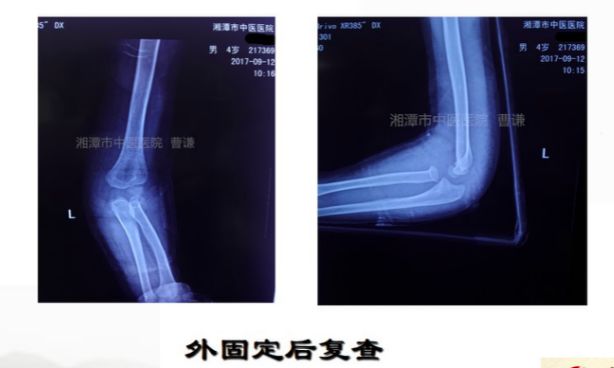 骨科医生必须掌握：桡骨颈骨折的7种治疗方法！