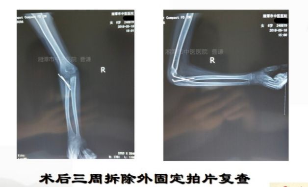 骨科医生必须掌握：桡骨颈骨折的7种治疗方法！