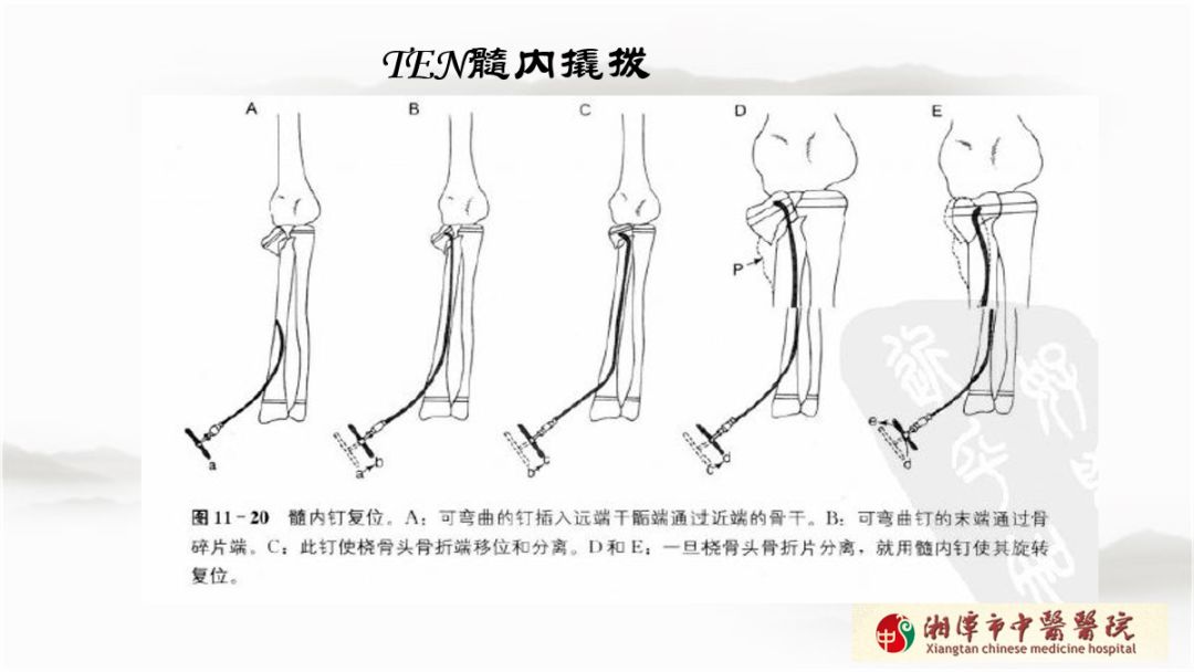 骨科医生必须掌握：桡骨颈骨折的7种治疗方法！