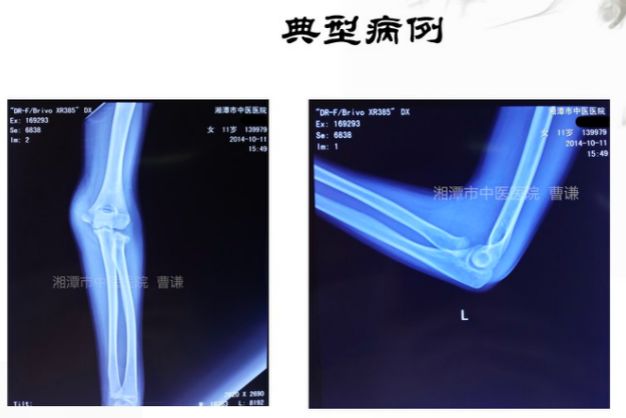 骨科医生必须掌握：桡骨颈骨折的7种治疗方法！