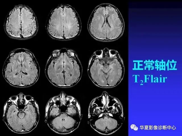 入门必修课：头颅MRI读片详解 - 好医术早读文章 - 好医术-赋能医生守护生命